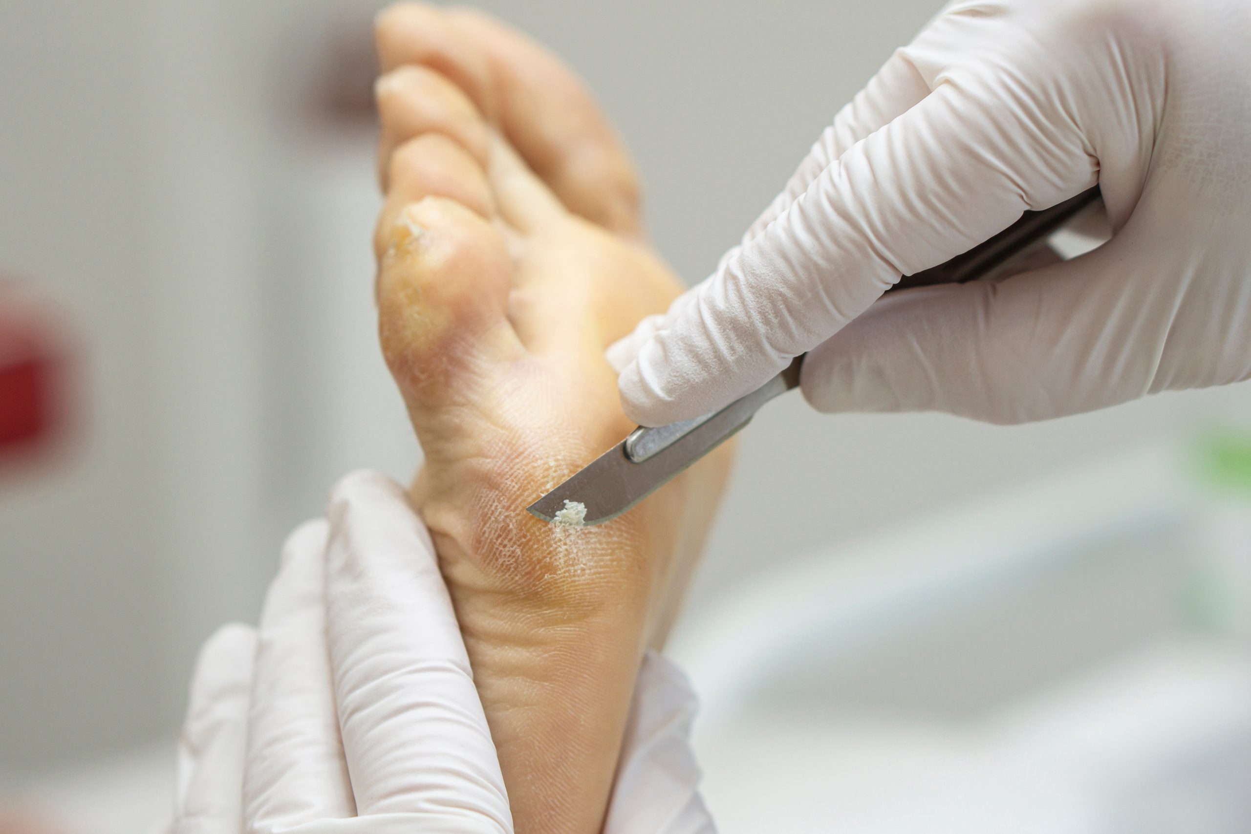 podologo eliminando verruga plantar